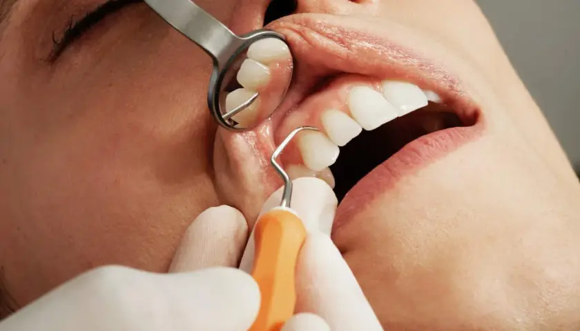 Dentysta usuwa kamień z zębów. Czy usuwanie kamienia boli? Zazwyczaj nie, ale zależy od wrażliwości pacjenta.