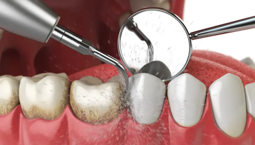 Zabieg odkamieniania zębów: ultradźwiękowe usuwanie kamienia nazębnego z widocznym strumieniem wody i odbiciem w lusterku dentystycznym.