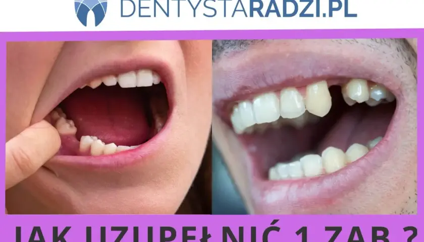 Dwa zbliżenia ust pokazujące braki w uzębieniu. Po lewej stronie widać palec wskazujący na brakujący ząb. Po prawej stronie widoczny jest brakujący ząb. Temat: hipodoncja.