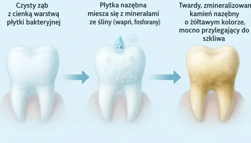 Proces powstawania kamienia nazębnego: od czystego zęba, przez płytkę mieszającą się z minerałami, aż do żółtawego kamienia z czarnymi kropkami.