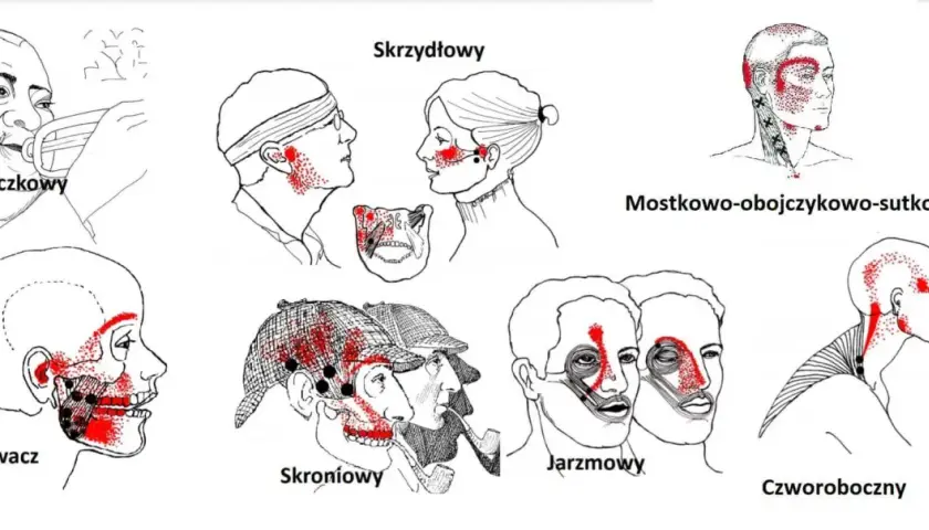 Ilustracje pokazują punkty bólu związane z różnymi typami bólu głowy, które mogą być mylone z objawami nowotworu stawu skroniowo-żuchwowego.