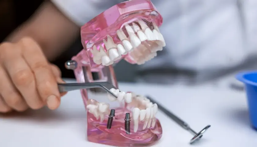 Model szczęki pokazuje wstawienie zęba. Pęseta trzyma protezę, która ma być umieszczona na implantach.
