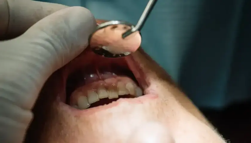 Dentysta używa lusterka, by sprawdzić, co wyciąga ropę z zęba.
