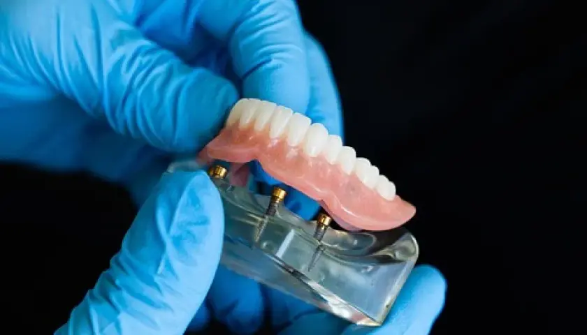 Ręce w niebieskich rękawiczkach trzymają model szczęki z implantami i cienkie protezy zębowe.