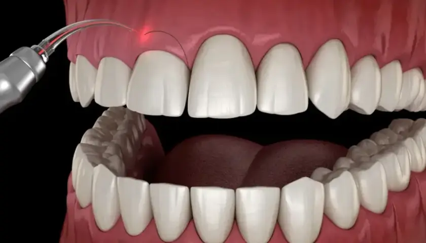 Zabieg gingiwektomii laserem. Precyzyjne modelowanie dziąseł dla pięknego uśmiechu.