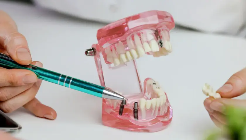Pokazano model szczęki z implantami. Dyskutujemy, co zamiast implantu, prezentując alternatywne rozwiązania protetyczne.