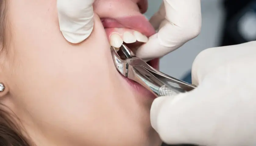 Dentysta wyrywa ząb kleszczami. Czy wyrywanie zęba boli? To zależy od znieczulenia i indywidualnego progu bólu.