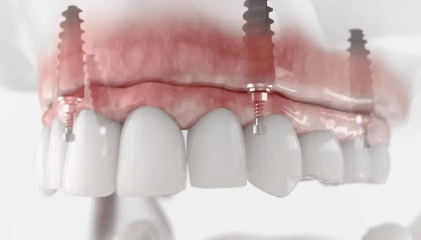 Model szczęki z implantami. Widoczne podniesienie dna zatoki szczękowej, przygotowanie do wszczepienia implantów.