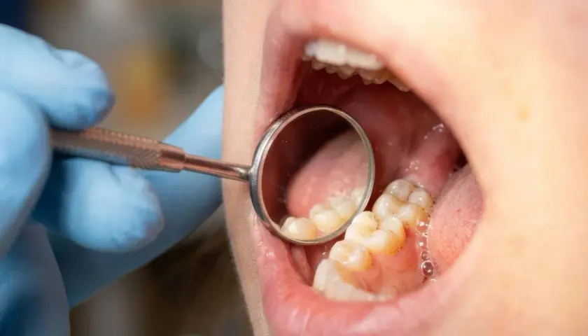 Dentysta w niebieskiej rękawiczce bada zęby lusterkiem. Widać na nich osad, który może być początkiem płytki nazębnej.