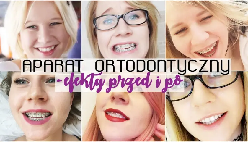 Aparat ortodontyczny a usta: Iluzja czy realna zmiana?
