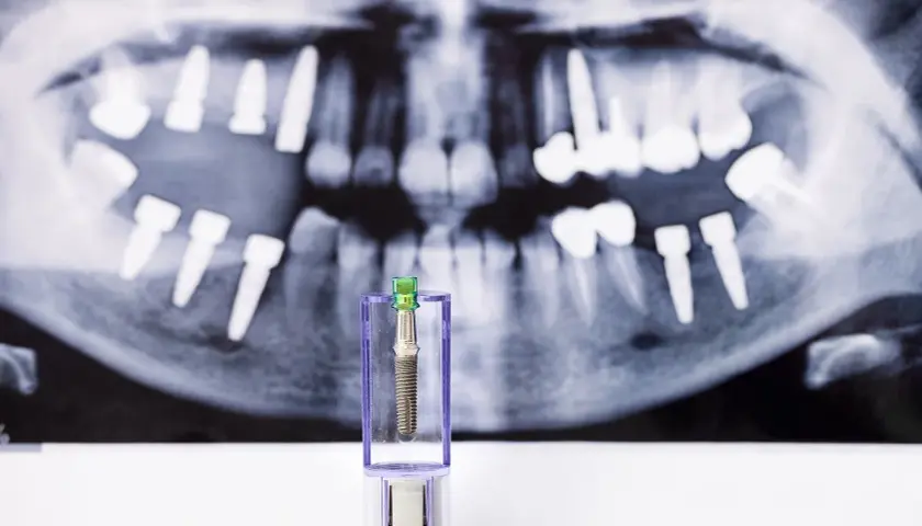 Zęby na zdjęciu RTG i implant w etui. Może to symbolizować odrzucenie implantu zęba lub jego przygotowanie.