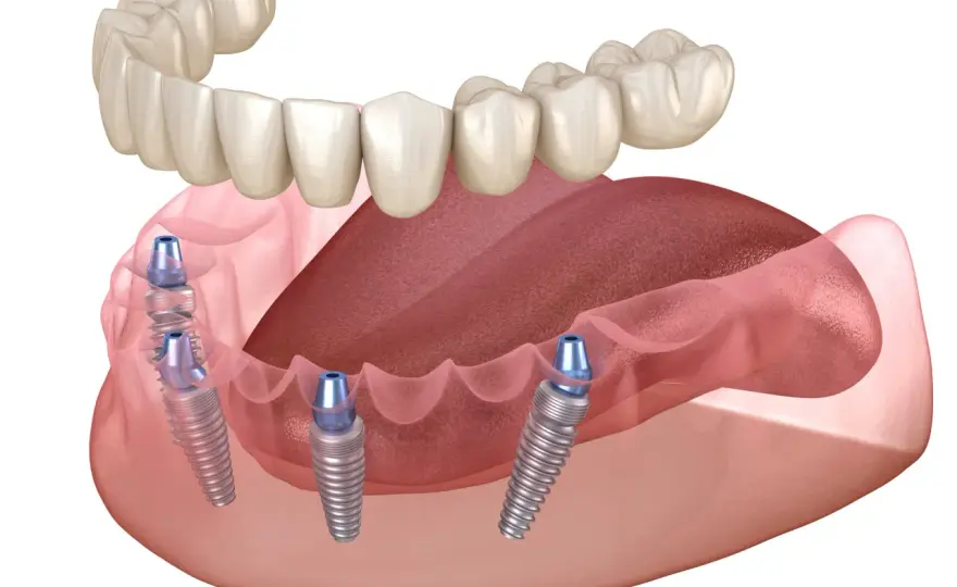 Proteza na implantach - jakie są opcje i ile to kosztuje?
