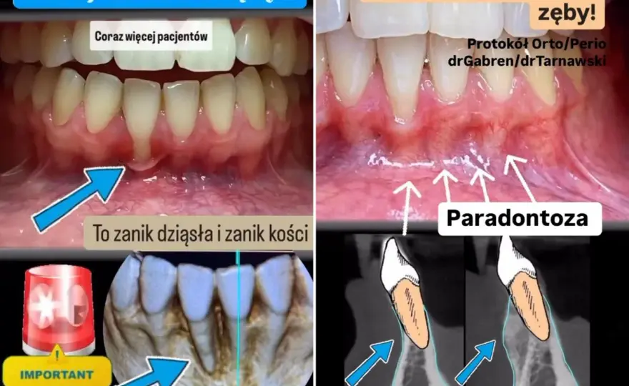 Recesja dziąseł - Co naprawdę widać na zdjęciach przed i po?