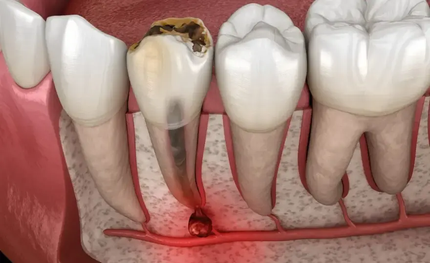 Endodoncja - Ratuj ząb, zanim będzie za późno!