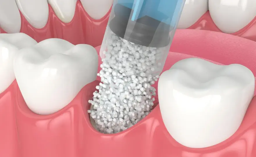 Augmentacja kości pod implant - Czy to zawsze konieczne?