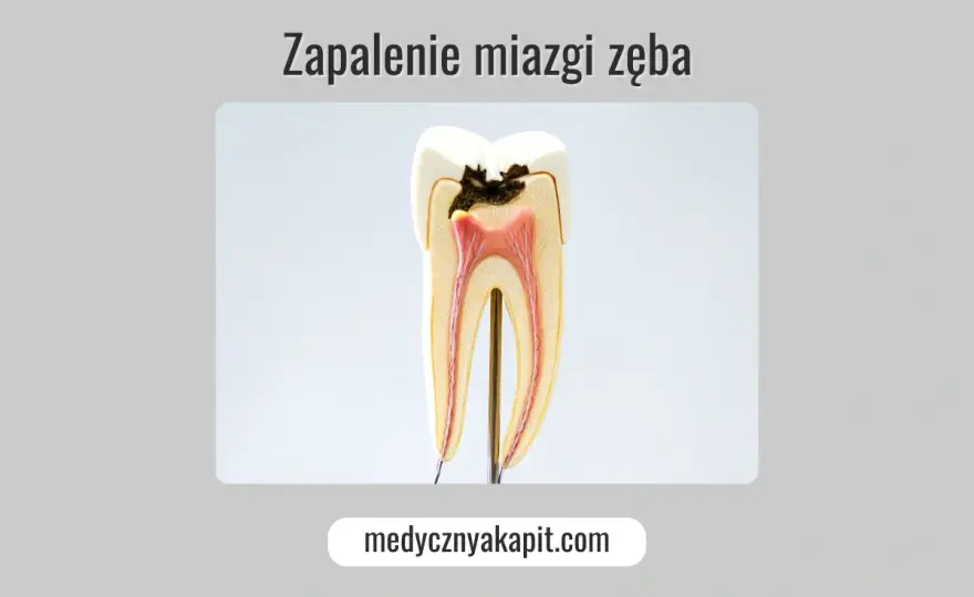 Zapalenie miazgi - poznaj objawy i uratuj swój ząb!