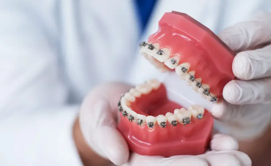 Technik dentystyczny a aparat na zęby - Co musisz wiedzieć?