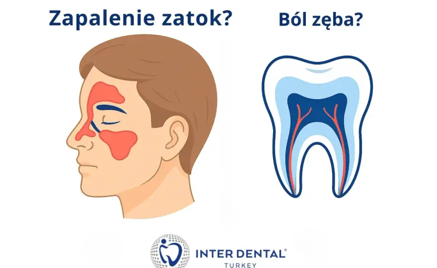 Zapalenie zatok szczękowych - Kiedy to ząb, a nie katar?