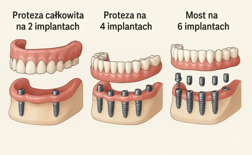 Ile kosztują protezy całkowite - porównanie cen i mądry wybór
