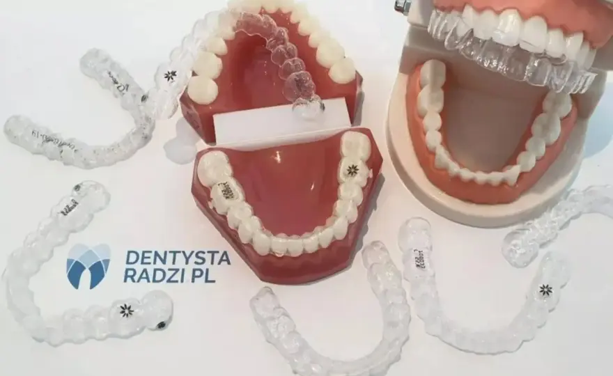 Nakładki czy aparat? Cena, komfort, skuteczność co wybrać?