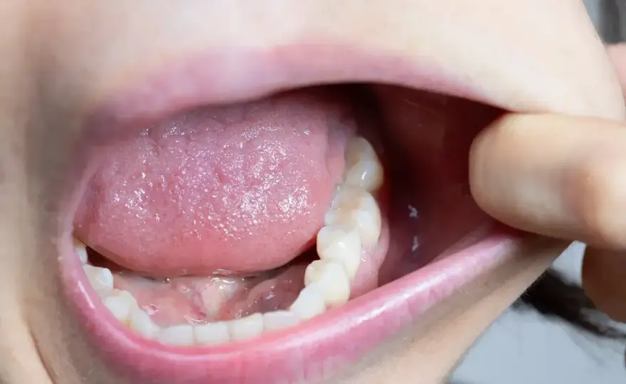 Afta w buzi - co pomaga, jak odróżnić i kiedy do dentysty?