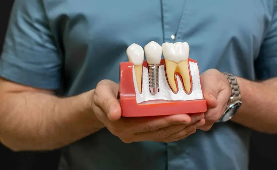 Implant zęba - Czy to najlepsze rozwiązanie dla Ciebie?