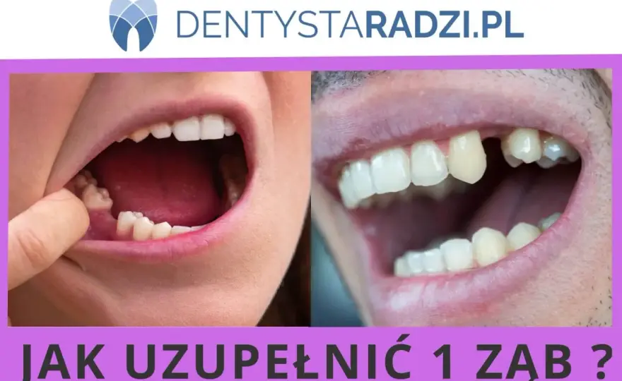 Brak zęba stałego - aparat czy implant? Ortodonta radzi