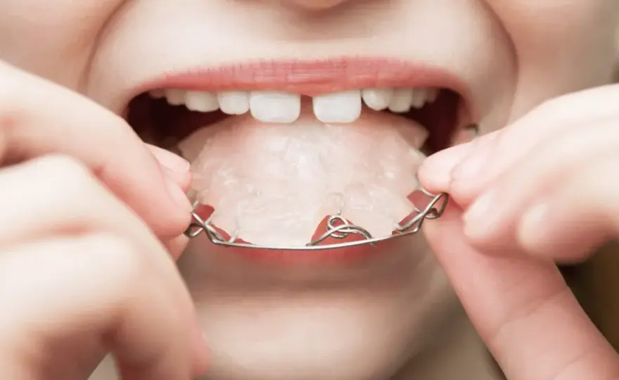 Aparat na zęby dla dziecka: Jak wygląda? Ruchomy, stały, Invisalign