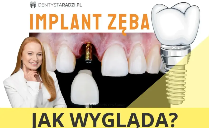 Implant zęba przed i po - Co zmienia się naprawdę?