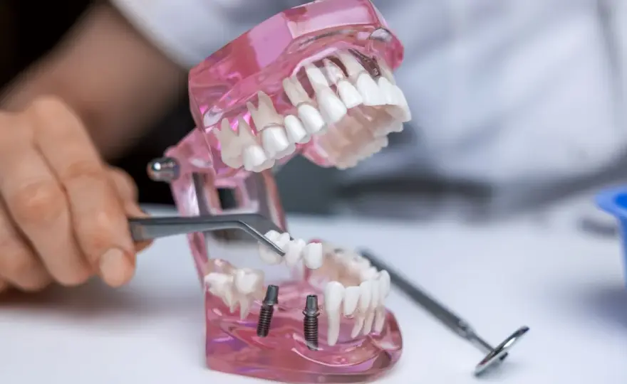 Wstawienie zęba - Implant, most, proteza? Wybierz mądrze