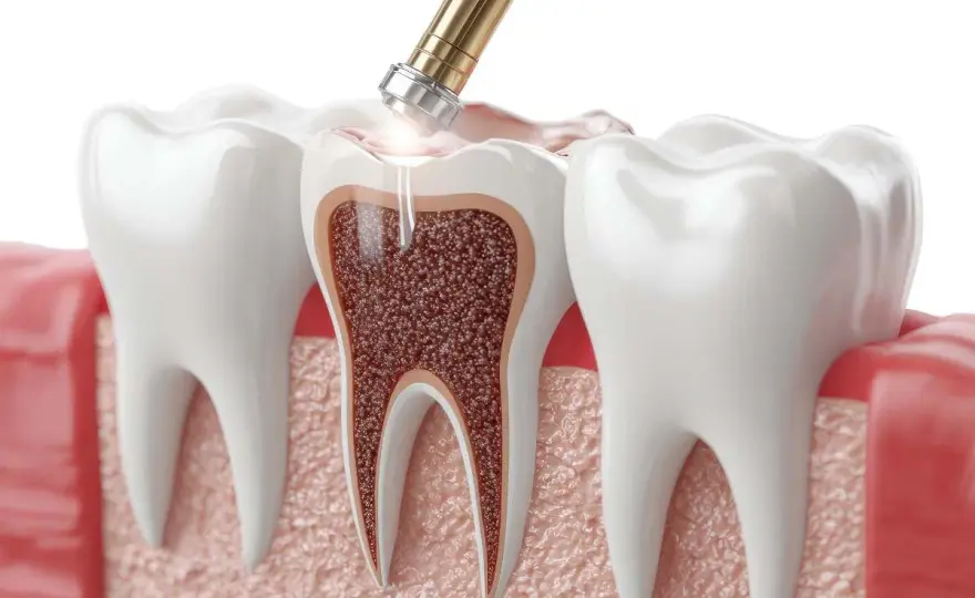 Ból po leczeniu kanałowym - Kiedy norma, kiedy do dentysty?