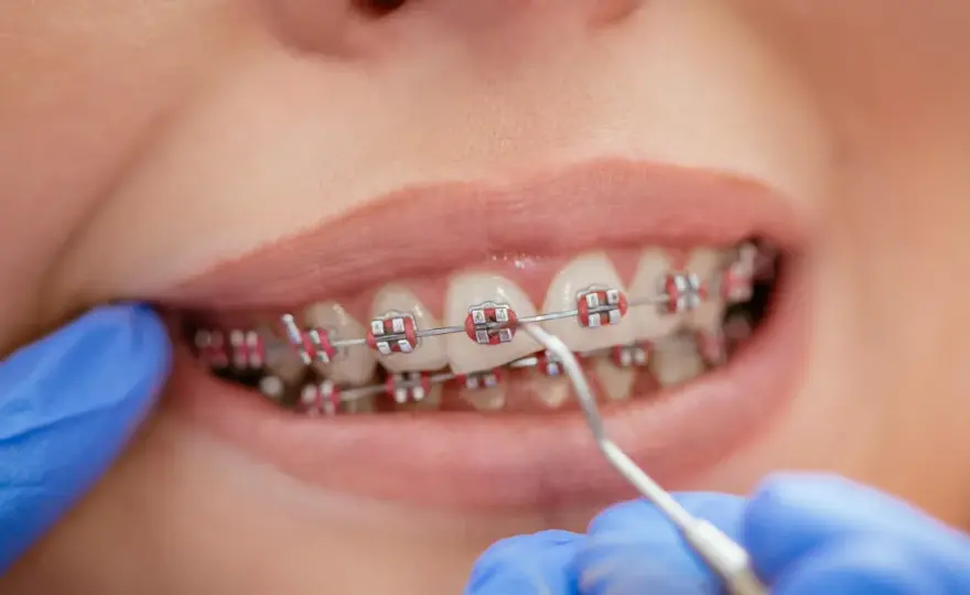 Kto zakłada aparat na zęby? Tylko ortodonta dlaczego to klucz?
