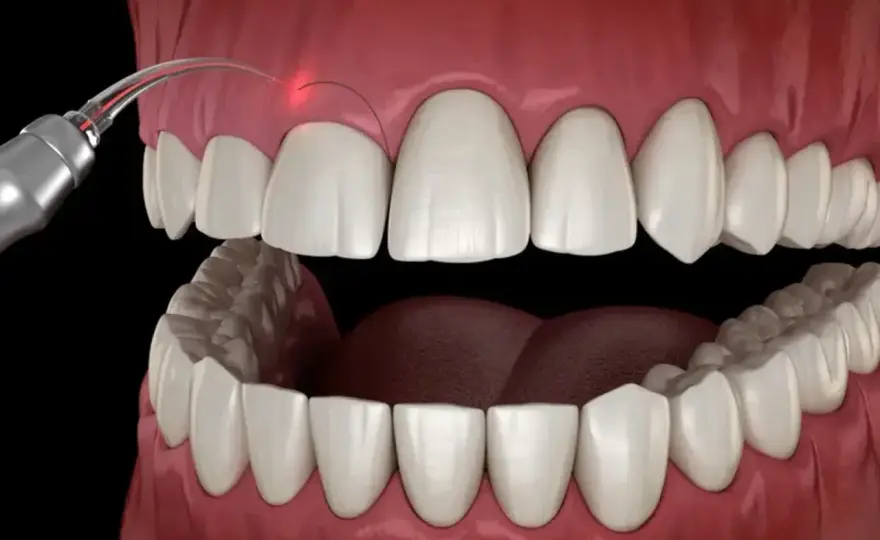 Gingiwektomia - Kiedy usuwanie dziąsła ma sens? Poradnik