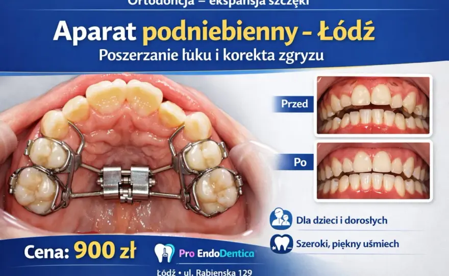 Wąski łuk zębowy? Aparat podniebienny - rodzaje i ceny