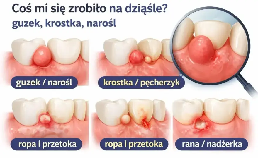 Antybiotyk na ząb z ropą: Co działa i kiedy do dentysty?