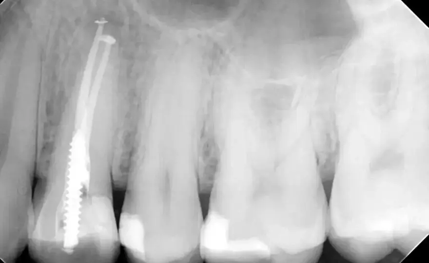 Pulsowanie po leczeniu kanałowym - Kiedy to normalne, a kiedy do dentysty?