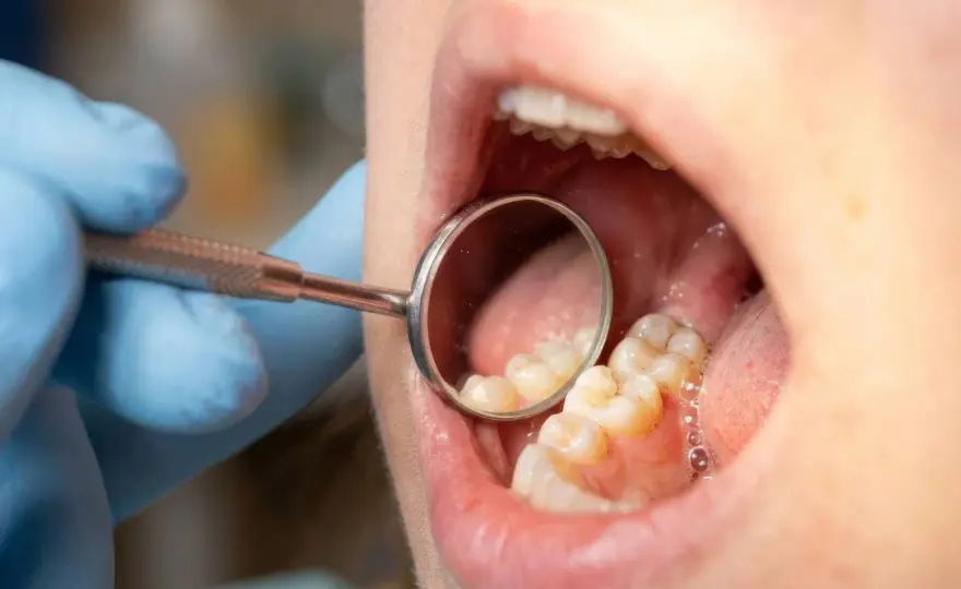Osad bakteryjny - chroń dziąsła. Kiedy do dentysty?