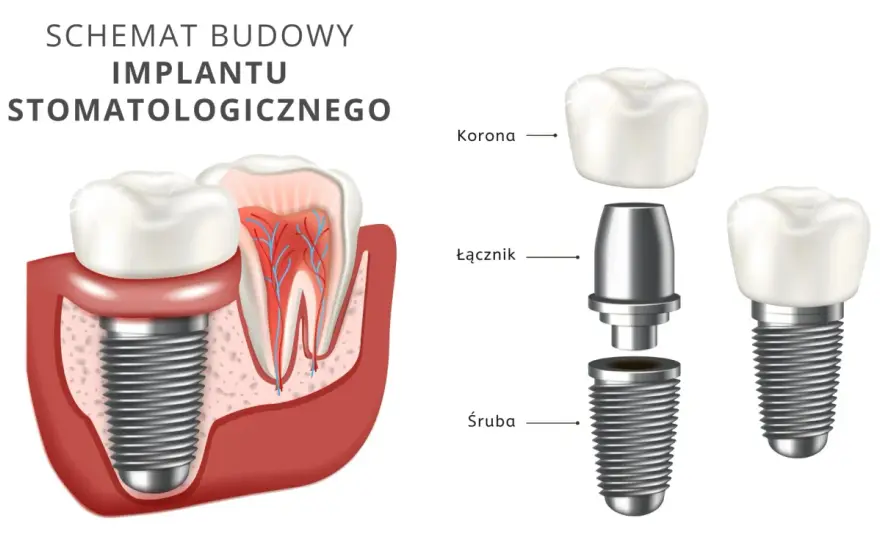 Ile kosztuje zrobienie zębów? Prawdziwe ceny i jak nie przepłacić