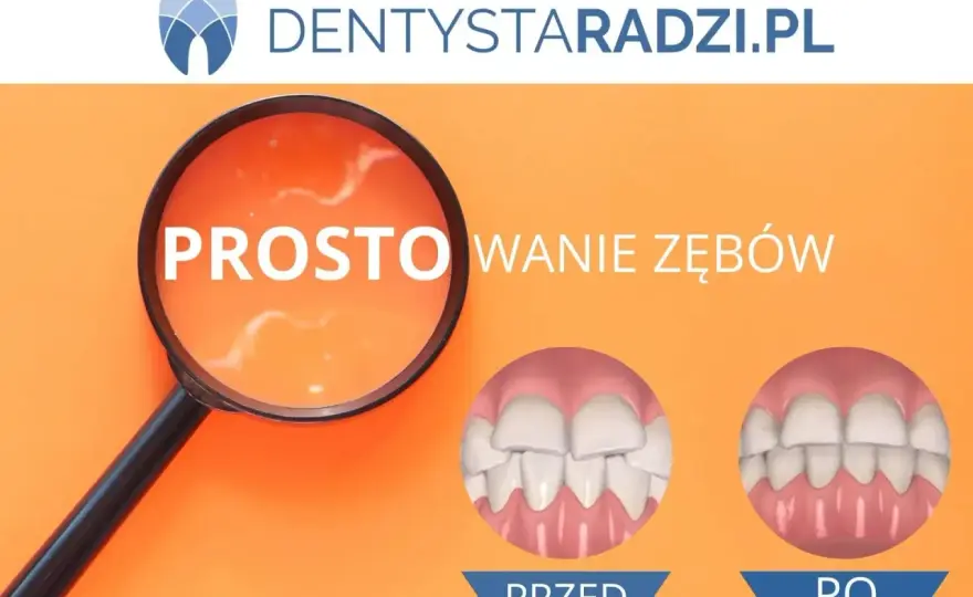 Licówki na krzywe zęby - Czy to prostuje? Sprawdź!