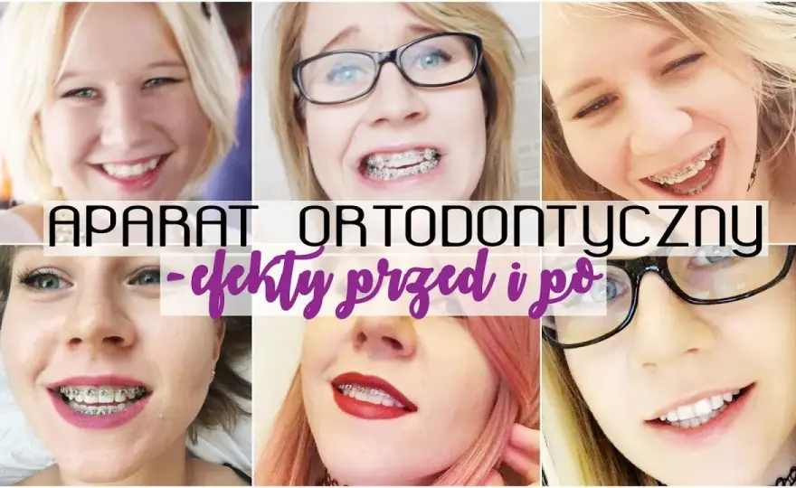 Aparat ortodontyczny a usta: Iluzja czy realna zmiana?