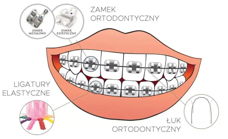 Jak działa aparat na zęby? Odkryj sekrety prostego uśmiechu!
