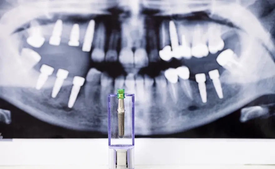 Odrzucenie implantu zęba - Co to naprawdę znaczy?