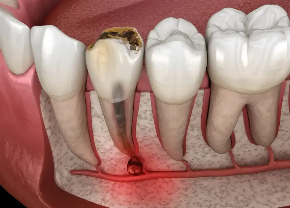 Zepsuty ząb z zapaleniem wierzchołka korzenia. To pokazuje, dlaczego endodoncja co to jest, jest ważna dla ratowania zębów.