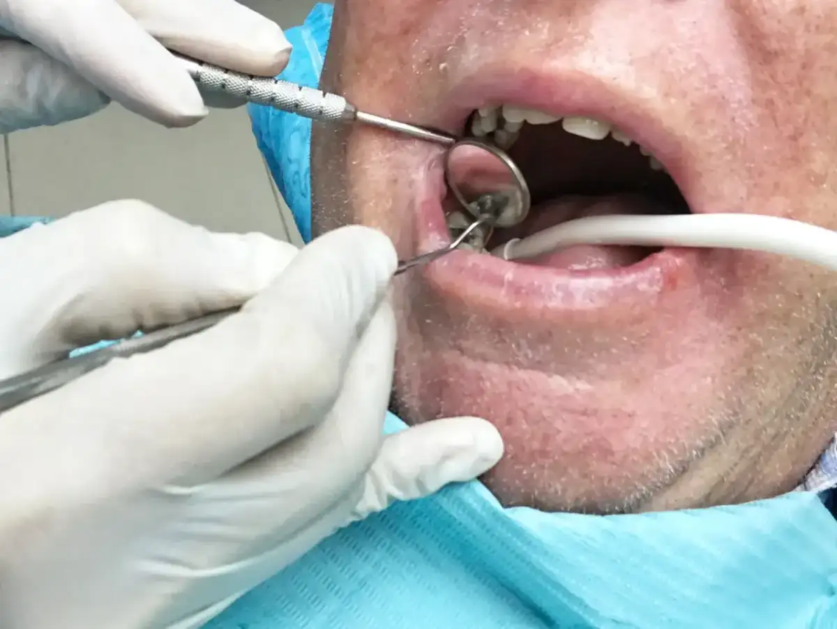 Dentysta w białych rękawiczkach wykonuje usuwanie korzenia zęba, używając lusterka i narzędzi.