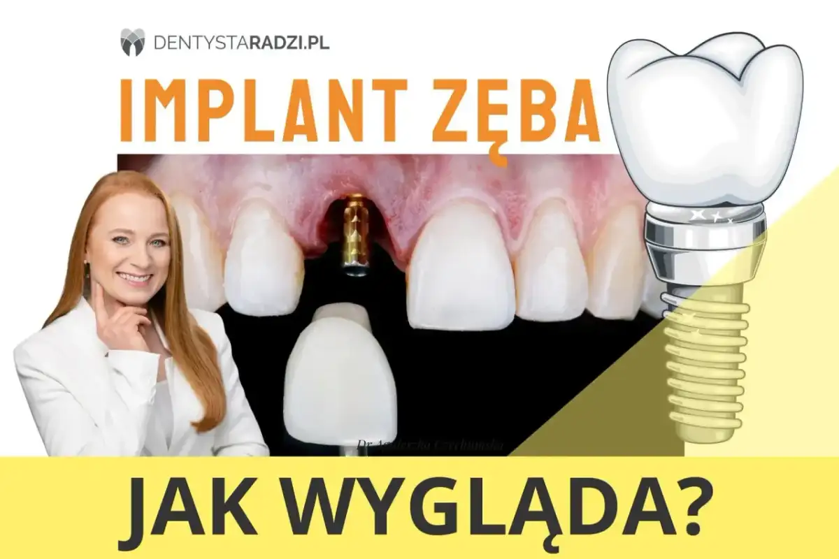 Implant zęba przed i po: widok na implant w dziąśle, protezę zębową i uśmiechniętą dentystkę.