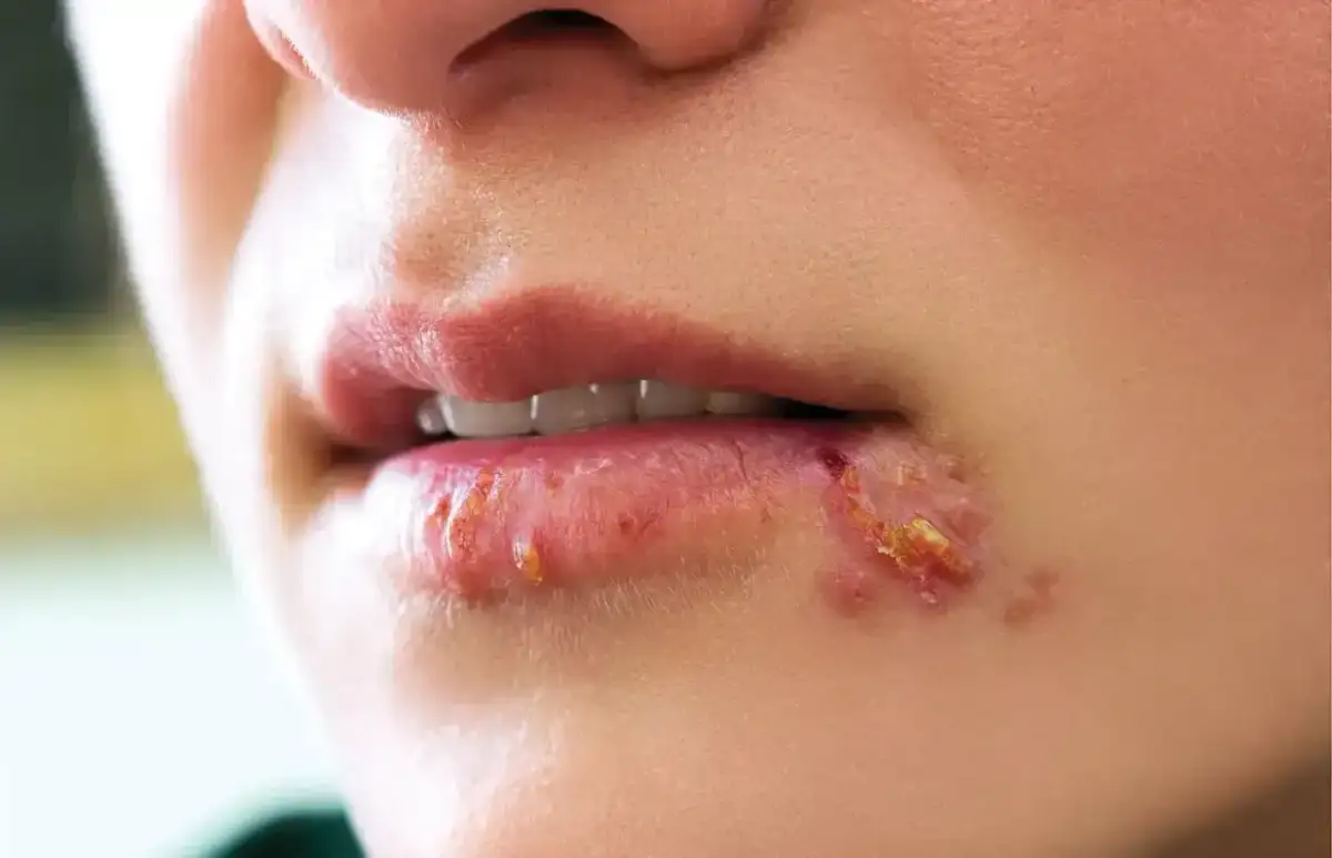 Usta z widoczną opryszczką. Czy z opryszczką można iść do dentysty? Warto skonsultować się z lekarzem.