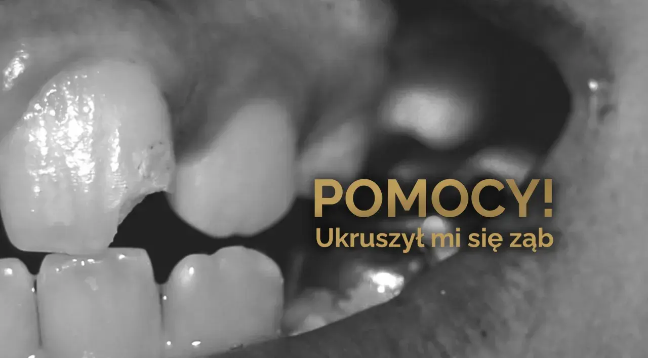 Zbliżenie na ukruszony ząb w jamie ustnej. Napis "POMOCY! Ukruszył mi się ząb" sugeruje pilną potrzebę interwencji dentystycznej.