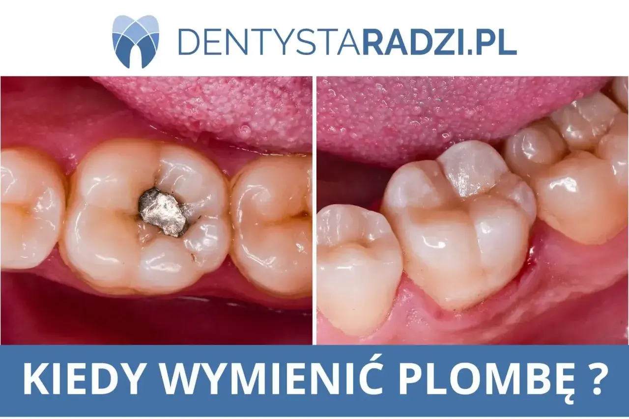 Porównanie zęba z amalgamatową plombą tymczasową i po jej wymianie na nową, estetyczną.