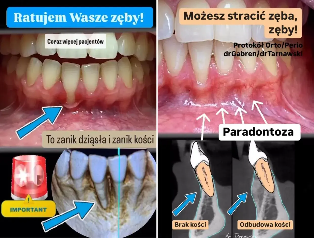 Przed i po leczeniu paradontozy: zanik dziąseł i kości, a następnie odbudowa. Ratujemy zęby!