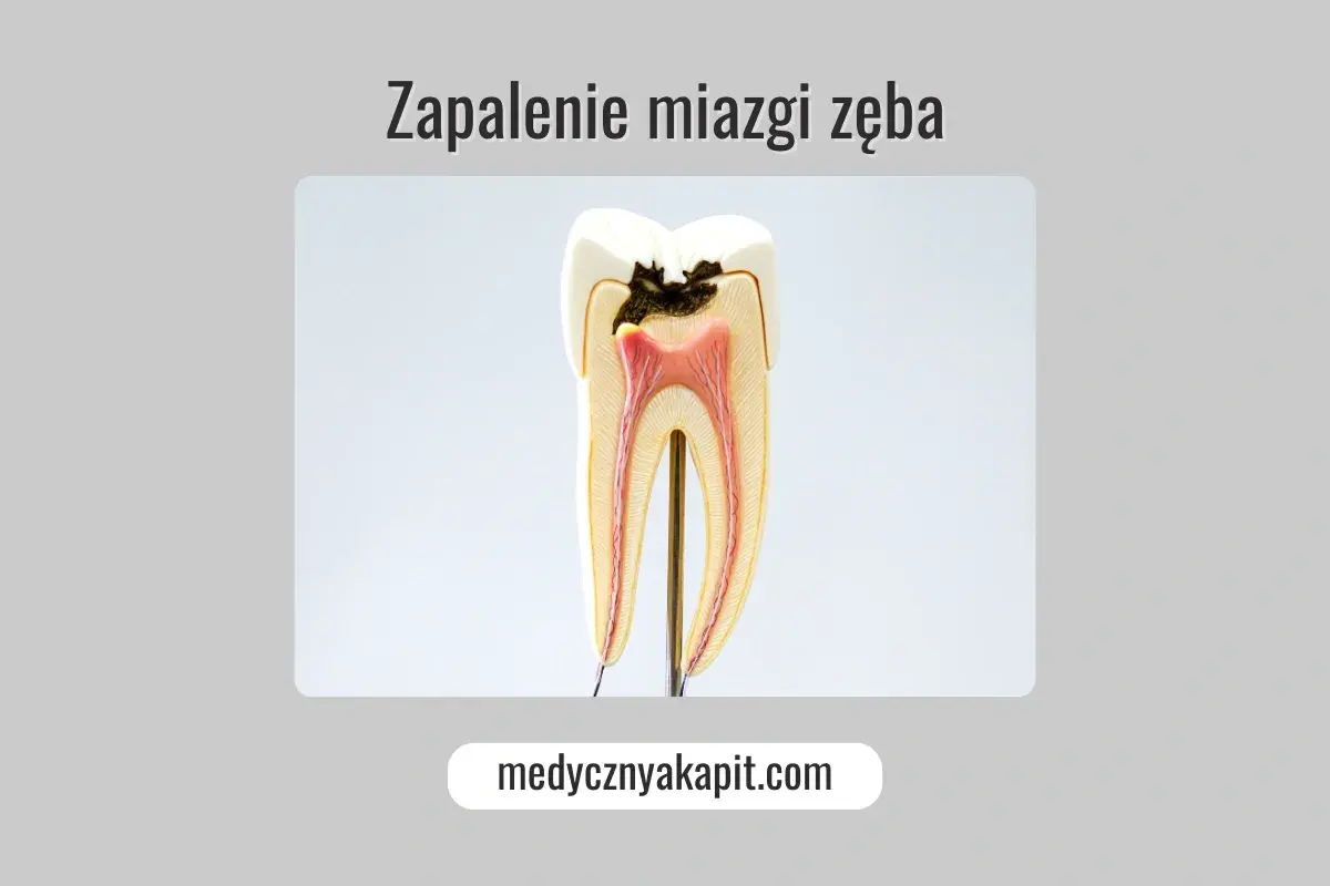 Model zęba ukazujący próchnicę i zapalenie miazgi. Widoczne są uszkodzone tkanki i czerwona miazga.